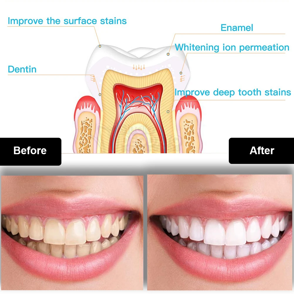 Dental Teeth Whitening Kit Min - Teeth Whitening With Hydrogen Peroxide review and price